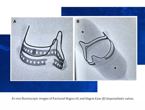 球扩SAFE丨生物瓣爆破与电外科技术：怎样选择辅助策略？